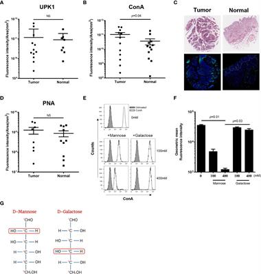 High mannose level in bladder cancer enhances type 1 fimbria–mediated attachment of uropathogenic E. coli